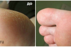 Обработка омозовелостей с внешней стороны большого пальца.