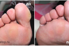 Обработка омозовелостей с внешней стороны большого пальца.
