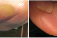 Обработка омозовелостей с внешней стороны большого пальца.