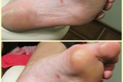 Гипергидроз