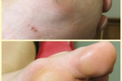 Гипергидроз2