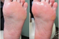 Обработка стоп при ксерозе — чрезмерной сухости кожи, сопровождающимся шелушением и трещинами