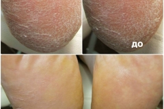 Обработка стоп при ксерозе — патологической сухости кожи.