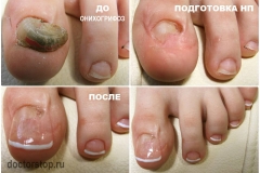 Онихогрифоз. Обработка — спиливание больного ногтя, удаление всех нестабильных частей НП. Протезирование.