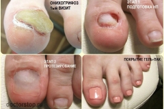 Онихогрифоз. Обработка — спиливание больного ногтя, удаление всех нестабильных частей НП. Протезирование. Декоративное покрытие гель-лаком.