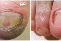 Обработка онихомикоза (грибковых ногтей). Подготовка ногтевых пластин к лечению.