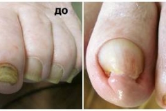 Обработка онихомикоза (грибковых ногтей). Подготовка к последующему лечению.