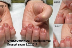 Онихомикоз ногтей на руках. В данном случае заражение грибком вида кандида (дрожжевой грибок). Первая обработка ногтей и результат после 10-ти дней активного лечения.