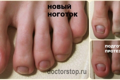 Протез