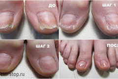 Протезирование2