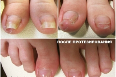 collageПротезВН1.1