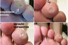 Стержн мозоль